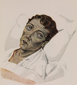 A 36 year old man suffering from asphyctic cholera. Wellcome Collection